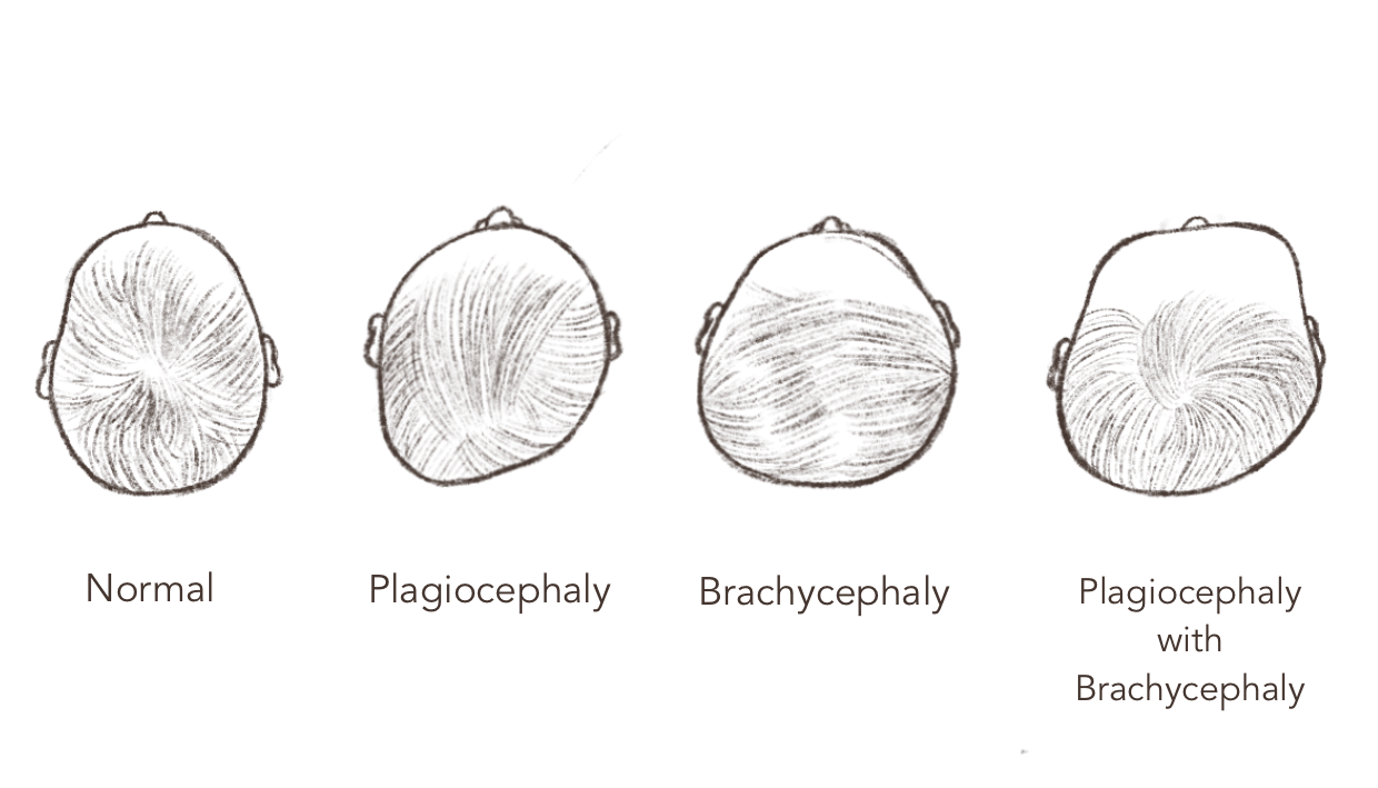 A pencil drawing that shows four infant head shapes: normal, plagiocephaly, brachycephaly, and plagiocephaly with brachycephaly